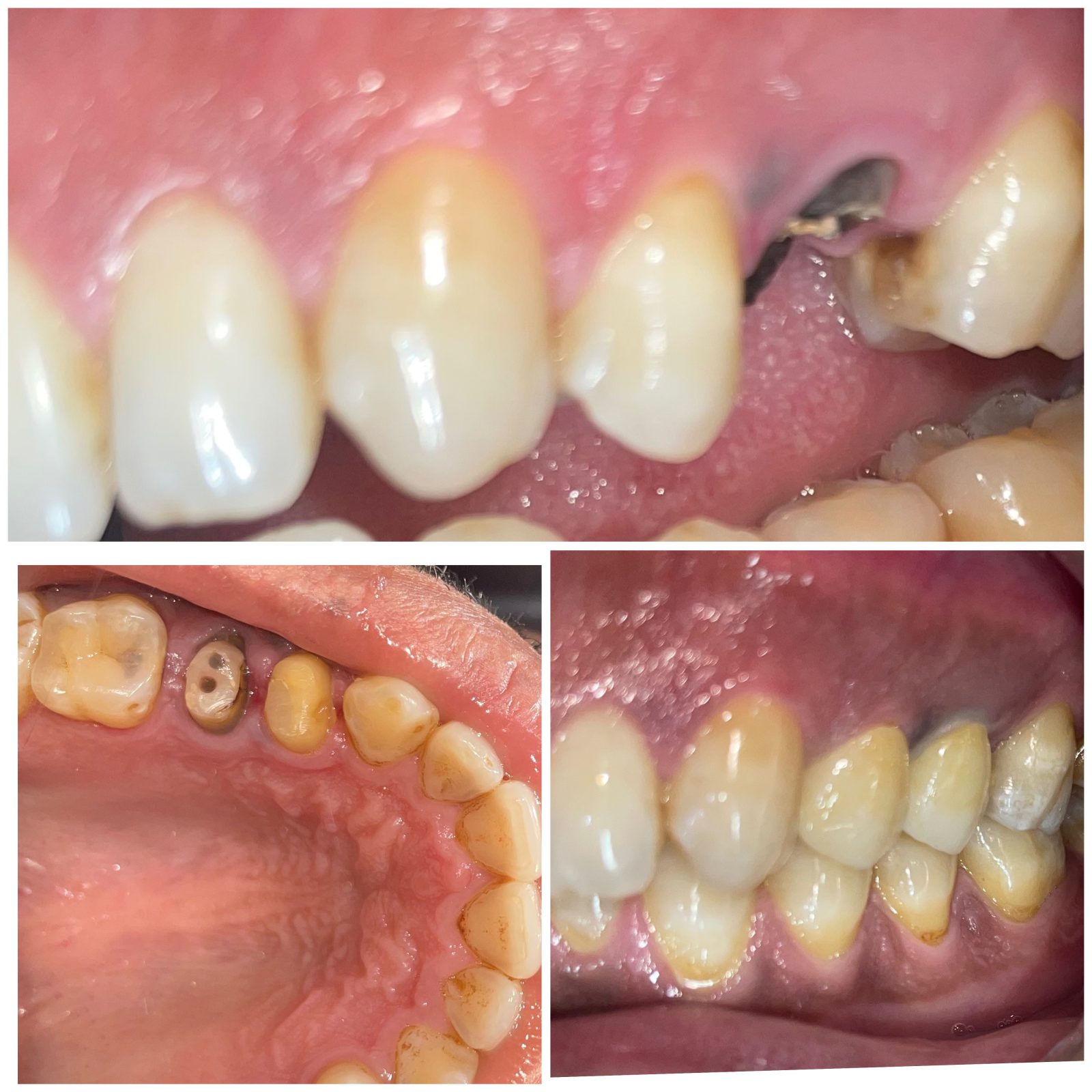 Post and Core Treatment